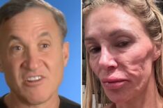 'Botched' Surgeon Dr. Terry Dubrow Shares Views on Brandi Glanville's 'Parasite' Face