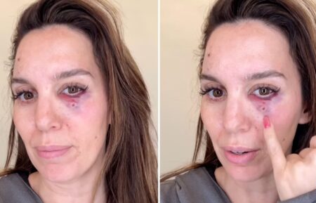 Christy Carlson Romano eye injury